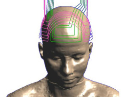 This is how an H coil fits on someone's head